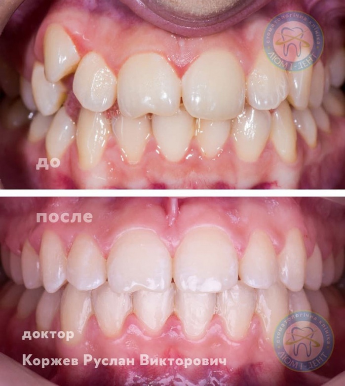 Кривые зубы у взрослых исправление фото Киев Люми-Дент